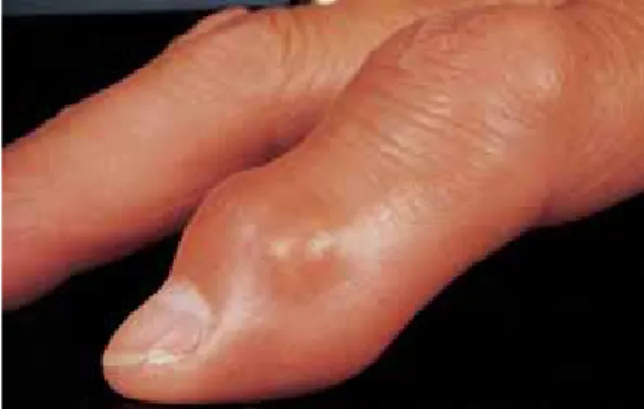 Fig. 10.10 Chronic tophaceous gout of the index finger.