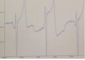 Fig 3: PCG Signal of a patient   