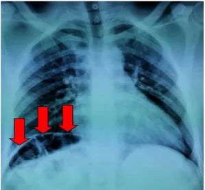 Figure 1. Plain radiograph showing gas shadow between liver and diaphragm. 