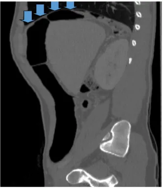 Figure 4. Abdominal CT sagittal section showing interposition of colic interposition be-tween liver and diaphragm