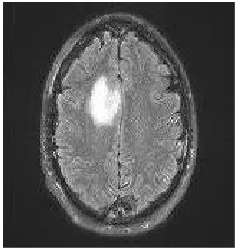 Fig. 1 Brain Tumor Image 