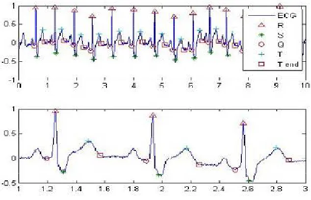 Fig. 4.  P r ol o n ga t i on  o f Q T  i n t e r va l  