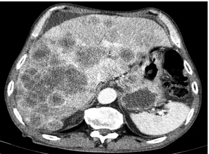 Figure 1. Computed tomography scan of abdomen showed gastric body wall thickening and extensive metastases with multiple hepatic lesions, intraabdominal fluid, perigastric and retroperitoneal lymphadenopathies