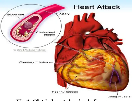 Fig 1: Clot in heart deprived of oxygen  