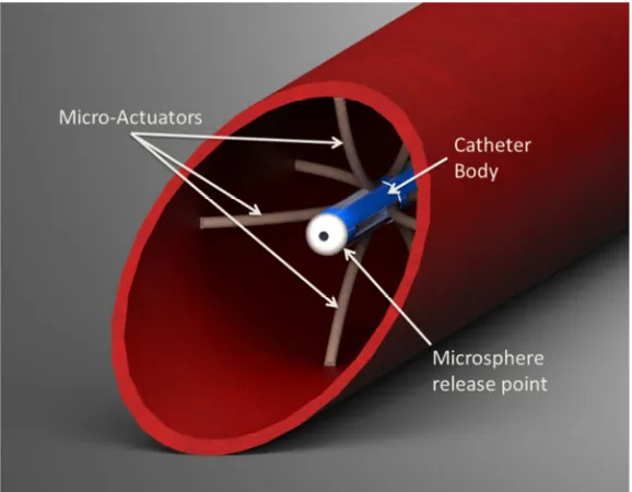 Figure 2. Catheter positioning inside hepatic artery 