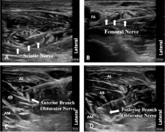 Figure 1. (A) Sciatic nerve block, (B) Femoral nerve block, (C) Anterior branch of the obturator nerve block, (D) Posterior branch of the obturator nerve block