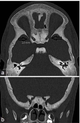 Figure 6. CT showing increased bone density and narrowed optic canals. Image courtesy of: 