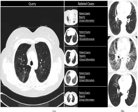 Fig. 1 (a) Example of a CAD interface for ILD within a CBIR framework. On the left the undiagnosed query exam,  slices are two patients with interstitial pulmonary fibrosis, respectively, in an early and late stage, and on the bottom a while on the right t