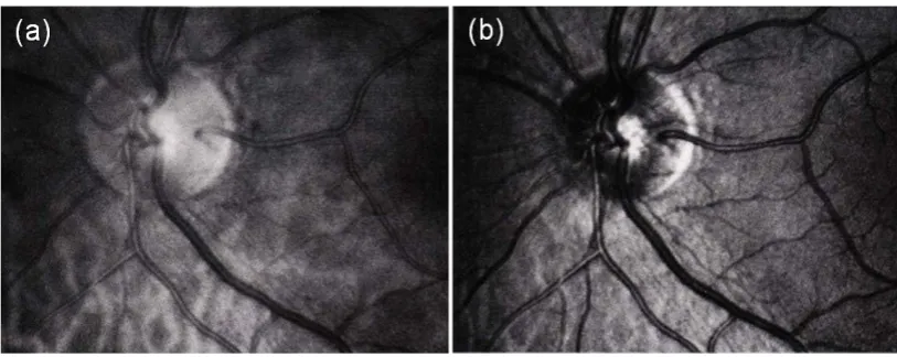 Figure 1.5 Examples of ONH scans of the same eye with a scanning laser 
