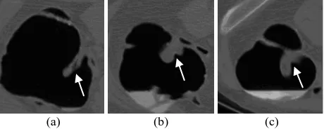 Fig.1. Examples of three different types of ICVs in CT images. (a) labial; (b) papillary; (c) lipomatous