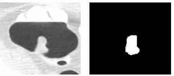 Fig.2. Example of a FP region in colon CAD. (left) CT sub-image; (right) FP region (the ICV is mistakenly detected as a polyp)