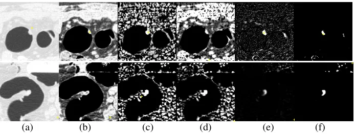 Fig.3. Results of the Bayesian method comparing two different shape features on two polyps (a) CT sub-image; (b) Intensity probability; (c) Shape index probability; (d) Joint (Bayesian) probability based on intensity and shape index probability; (e) K2 flo