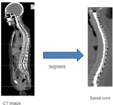 Figure 1 shows CT image and Spinal cord. From the CT images we can segment Spinal cord by some methods