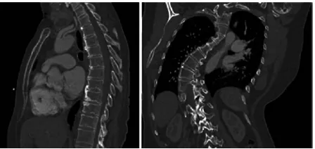 Fig -2: Spines of a normal and abnormal person 