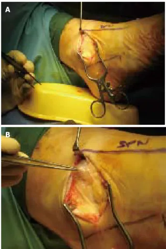 Figure 1  Portal Placement and set-up for ankle arthroscopy. B
