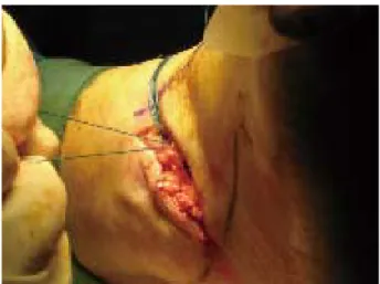 Figure 5  Imbrication of the lateral structures with a retinacular reinforcement.