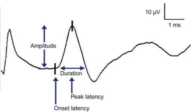 Fig: 8 Waveform of sensory nerve conduction