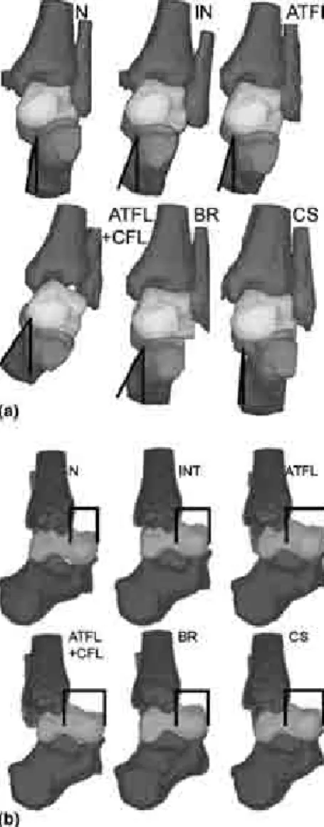 Fig. 3. Surface renditions showing qualitatively, on one specimen, the eﬀect of sectioning the ATFL and CFL ligaments and of simulated surgical reconstruction on the mechanical response of the ankle complex to: (a) inversion (frontal plane) and (b) anterio
