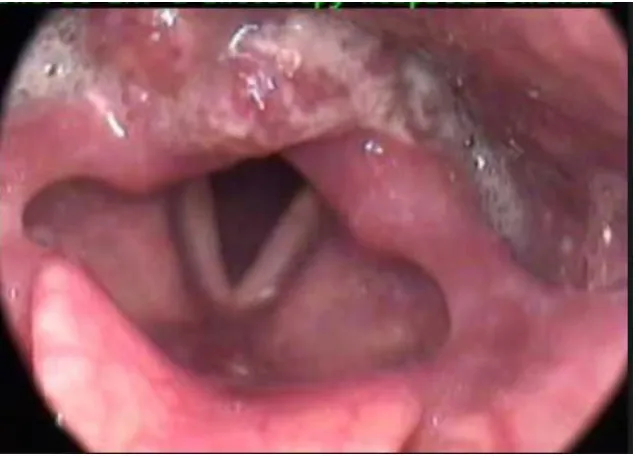 Fig 31: Malignancy Postcricoid region, Adapted from Google Images 