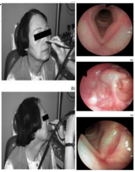 Fig 38: Head torsion technique and the corresponding laryngoscopic images, Adapted from Tsunoda A et al Head torsion technique for detailed observation of larynx and hypopharynx
