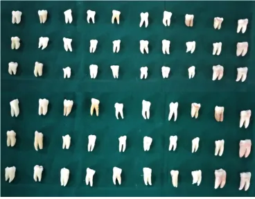FIGURE 2: DECORONATED MANDIBULAR MESIAL ROOTS 
