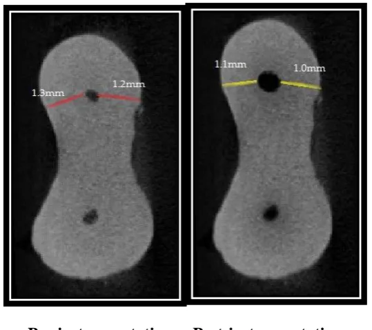 FIGURE 10:  MICRO-CT IMAGE AT 3MM FROM APEX PTU GROUP 
