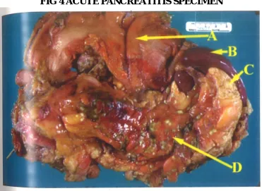 FIG 4 ACUTE PANCREATITIS SPECIMEN