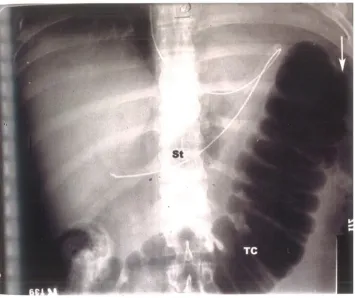 FIG 5  X RAY SHOWING COLON CUT OFF SIGN 