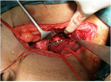table. Skin incision is placed lateral to the posterior superior iliac spine, 