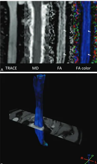 FIG 2. Aview of the spinal cord.of ﬁbers obtained after probabilistic tractography displayed in a directional mode and regis-tered on the T2-weighted image