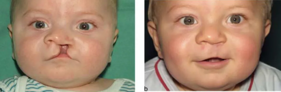 Figure 8 Complete unilateral cleft lip and palate – pre- and post-op views.