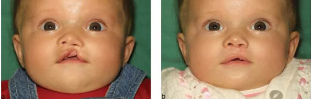 Figure 4 Incomplete unilateral cleft lip – pre- and post-op views.