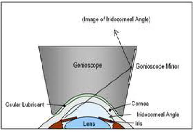 Figure 8 : Gonioscopic view of Angle Structures  