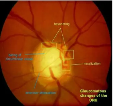 Figure 14 : Glaucomatous changes of optic disc 