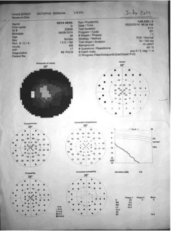 Figure 15 : Octopus perimetry of a patient showing bi-arcuate field defects 