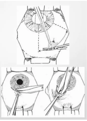 Figure 16: Conjunctival flaps 