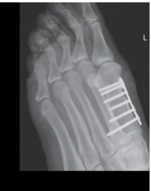 Fig 3: : 1stmetatarsal shaft fractures treated with plating
