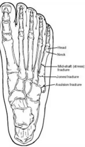 Fig 5: Locations of fracture zones for proximal fifth metatarsal fractures