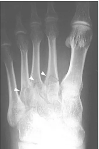 Figure 6 : Nondisplaced fractures of the proximal portions of