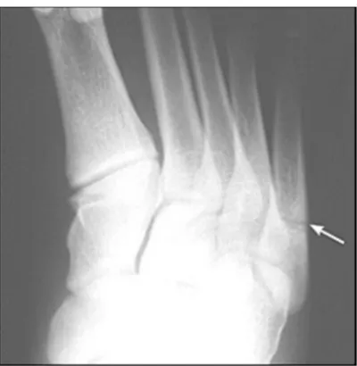 Fig 7:Jones fracture