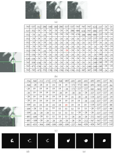 Figure 10: An example of segmentation of an attached nodule. (a) Original 3D nodule on three contiguous slices; (b) intensity modemap and its corresponding intensity mode values based on 4D mean shift clustering (without shape); (c) intensity mode map and 