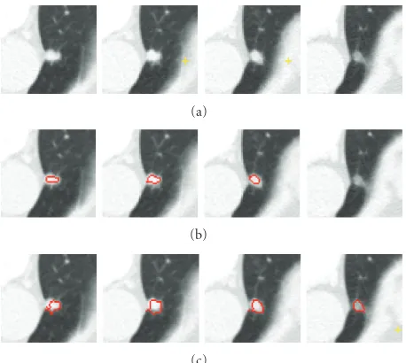 Figure 13: Segmentation of a colonic polyp. In (a), we show a 3Dpolyp in three contiguous slices, in (b) segmentation results withoutthe shape feature, and in (c) segmentation results based on theproposed method.