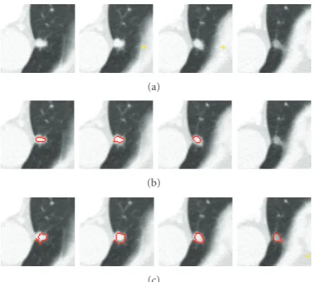 Figure 13: Segmentation of a colonic polyp. In (a), we show a 3Dpolyp in three contiguous slices, in (b) segmentation results withoutthe shape feature, and in (c) segmentation results based on theproposed method.