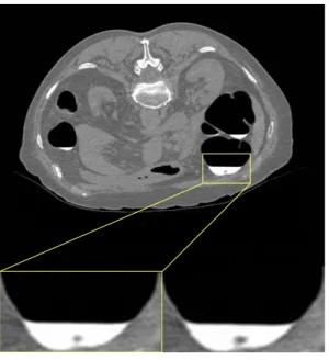 Fig. 1. A CT image with a submerged polyp. Original image(bottom left) and PEH corrected image (bottom right)
