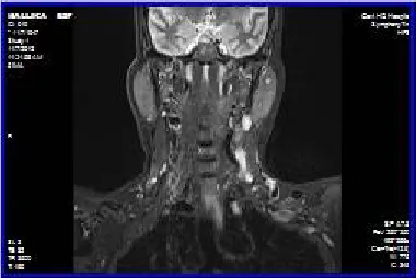 Fig.6. (a). MRI Scan Noisy Neck image, (b). Average Magnitude Image, (c). Density of the Edge Length,   (d)