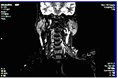 Fig 7 (c). Binary Edge detection image  