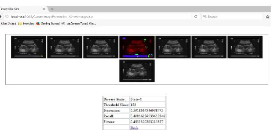 Fig. 3 Result- Colour transform Segmented USG images with disease stage, Threshold Value, Precision, 