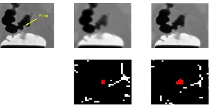 Figure 1. Shape index feature detector : original sub-image including a polyp (left), Gaussian smoothing (middle) andAdaptive diﬀusion smoothing (right) and the zoomed resulting shape index features images at 80% around the polyp.