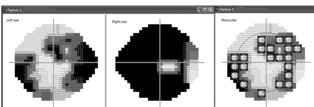 FIGURE 1.Integrated VF: the monocular sensitivity scores from the right and left eyes are combined to generate a binocular simulation, thesensitivity values of which are based on the sensitivity of the better eye at each location