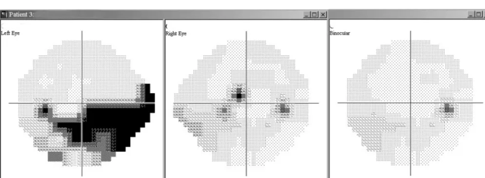 FIGURE 7.Example A. VF defect (gray scale): right eye MD �12.6 dB, left eye MD �16.5 dB, and IVF score 34.